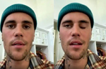 Justin Bieber suffering from face paralysis on right side, shows he cant blink or smile